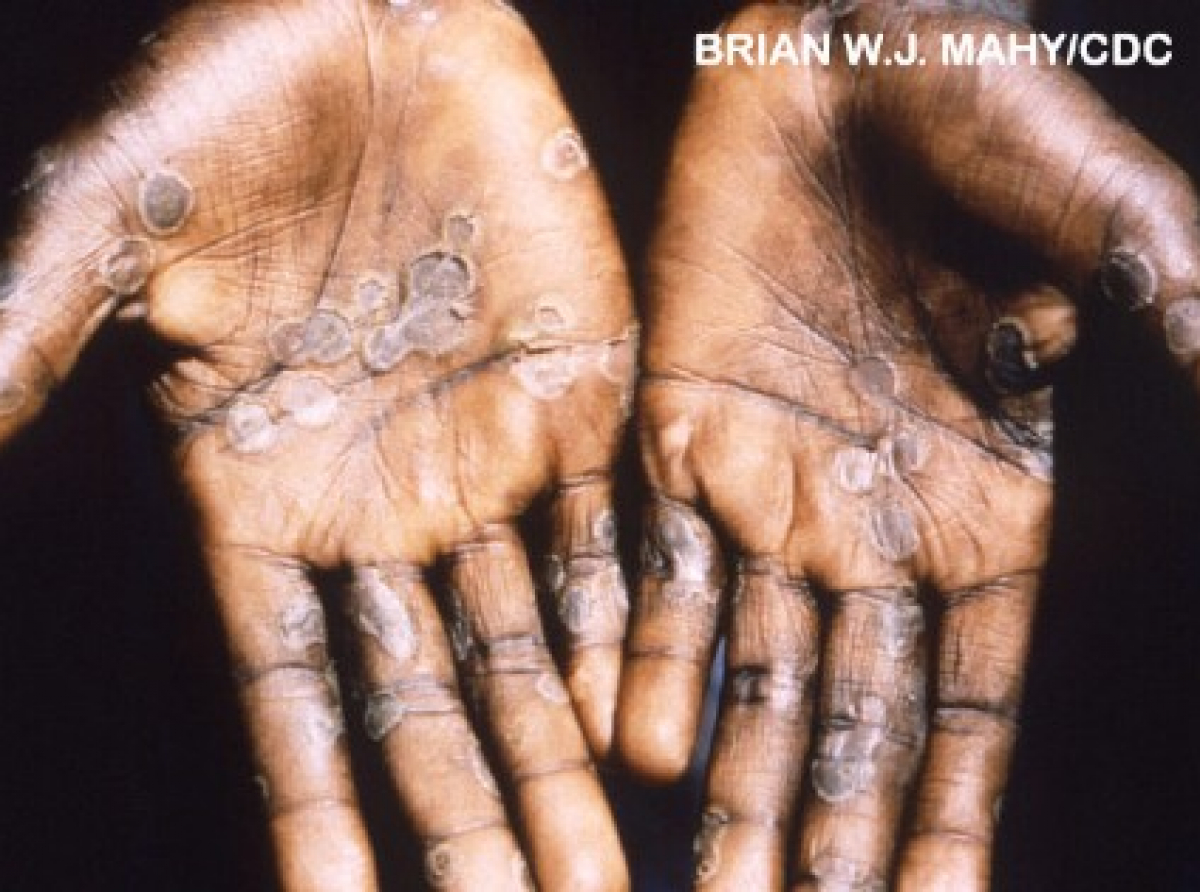 WHO: Monkeypox Outbreak Detected in 11 Countries