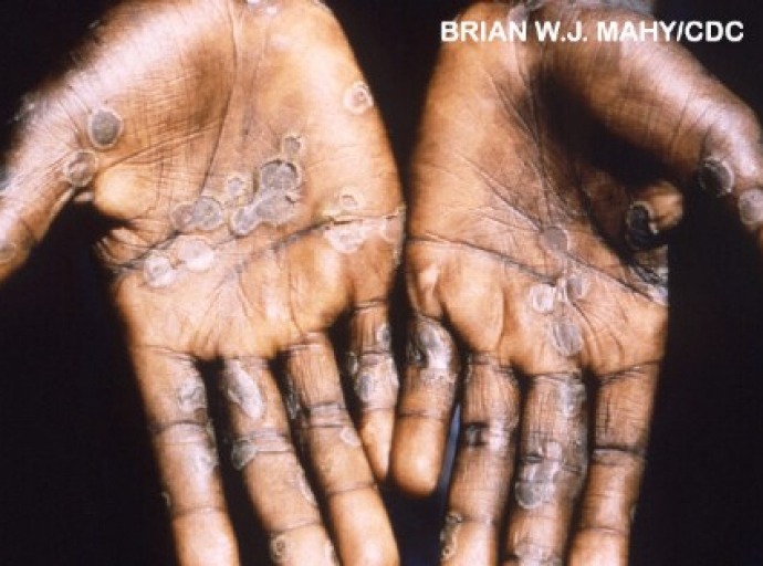 WHO: Monkeypox Outbreak Detected in 11 Countries