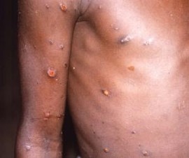Photo credit: CDC / Brian W. J. Mahy
